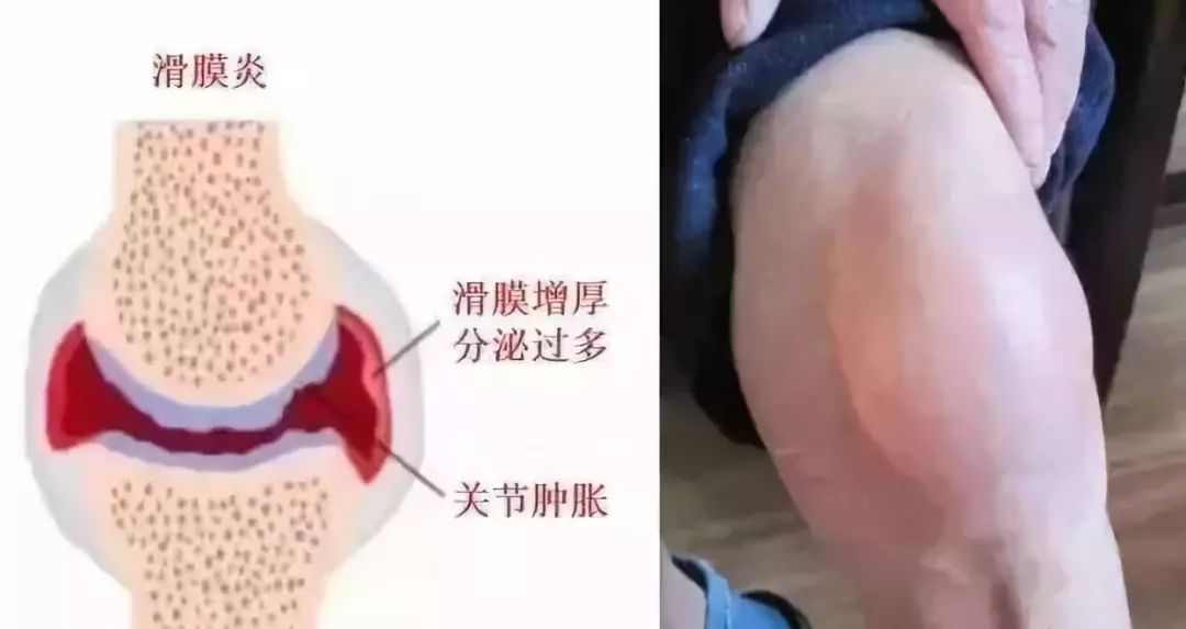 滑膜炎康复训练，90%的人都犯过这些误区！