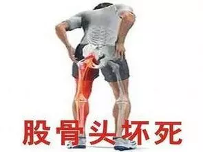 老人胯骨(髋关节)痛,是不是就是股骨头坏死了?