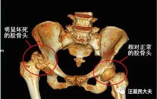 老人胯骨(髋关节)痛,是不是就是股骨头坏死了?