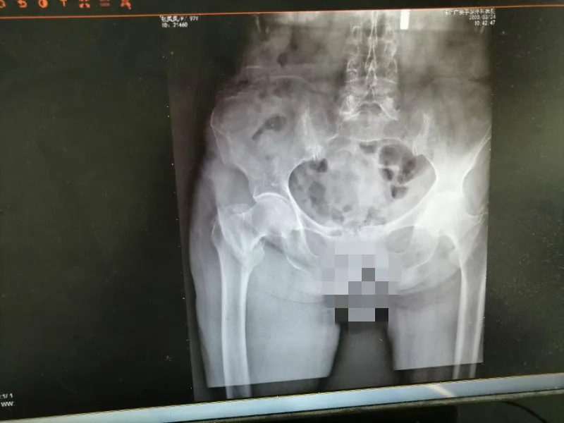痛心,92岁老人髋部骨折,广安医院妙手回春
