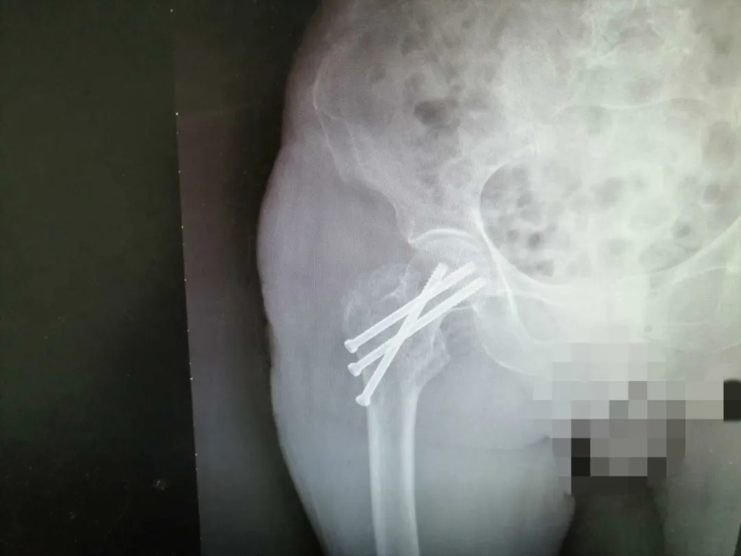 痛心,92岁老人髋部骨折,广安医院妙手回春