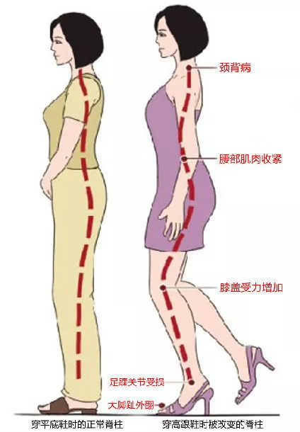 自测一下,看看你的腰突是哪个程度?