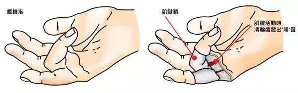 手指疼痛难以伸直?快来看看是不是得了腱鞘炎!
