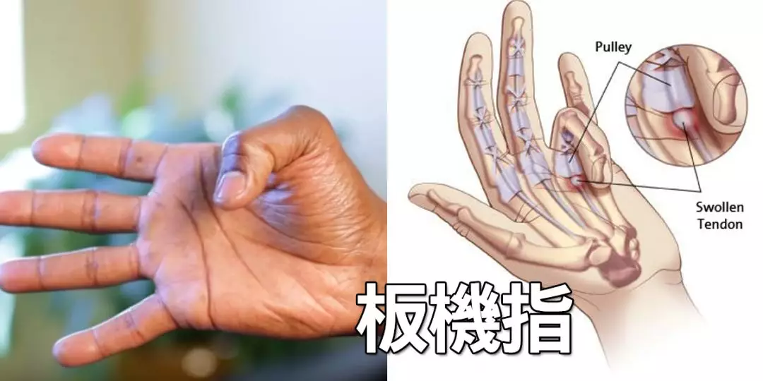 手指疼痛难以伸直?快来看看是不是得了腱鞘炎!