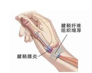 手腕酸痛的几个原因