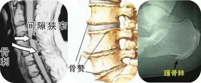 长骨刺了怎么办,可以消除吗?