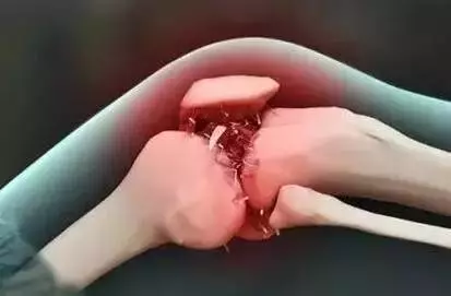 长骨刺了怎么办,可以消除吗?