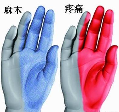 半夜“手麻”?快看看自己是不是得了这种病