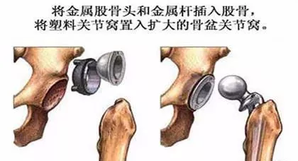 年纪轻轻,置换人工关节有问题吗