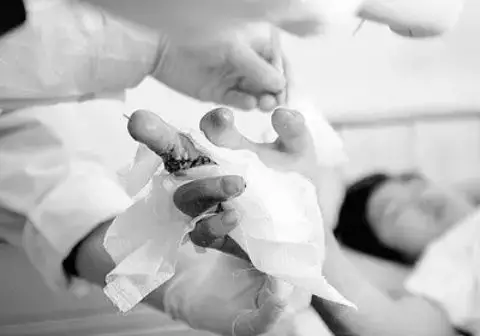 发生断指外伤后的急救处理