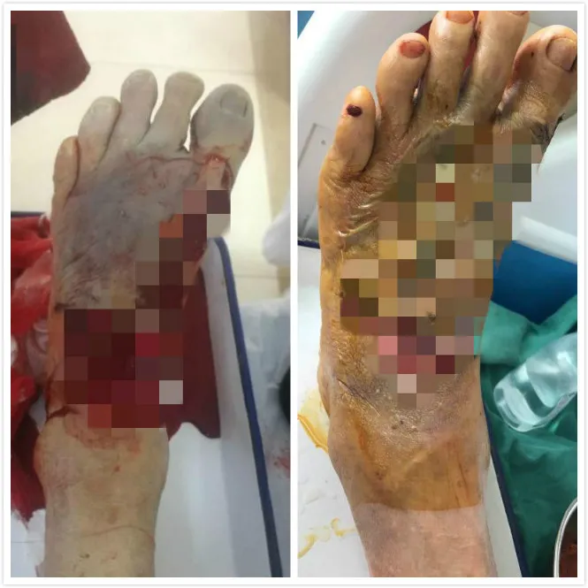 车祸受伤触目惊心 植皮手术妙手回春