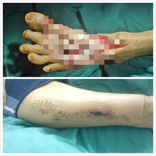 车祸受伤触目惊心 植皮手术妙手回春