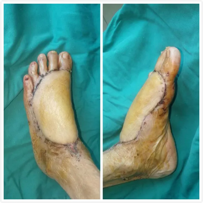 车祸受伤触目惊心 植皮手术妙手回春