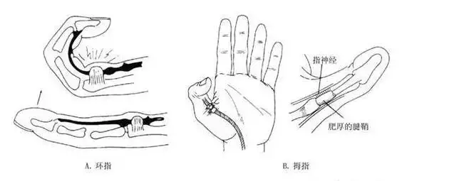 宝宝手指伸不直 关节"噼啪"响 要注意了