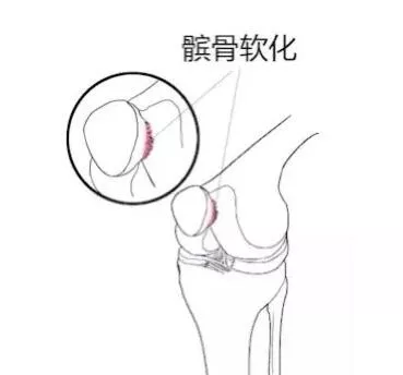 膝盖越动越痛是怎么回事?