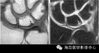 腕部疼痛,不要总让腱鞘炎背锅!
