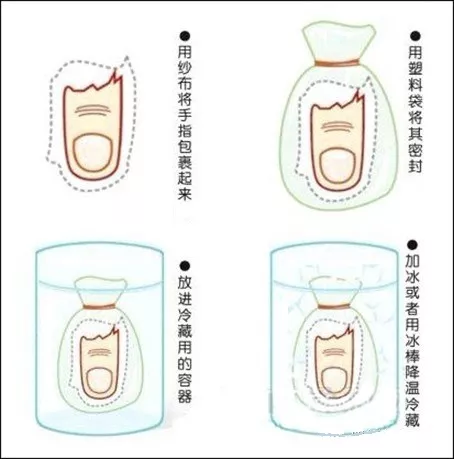 手指断了能接好吗?注意这几点