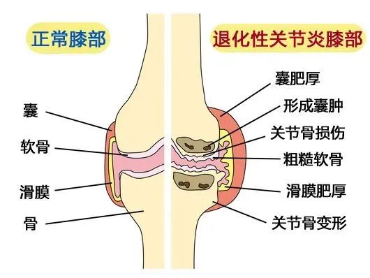 健康科普| 远离中老年退行性关节炎，看这篇文章！