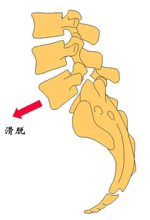 腰疼就是腰间椎盘突出？可别判断错了！